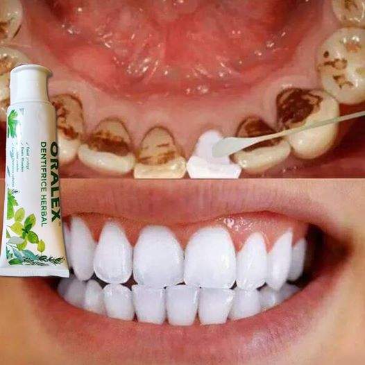 منتوج تبييض الأسنان وازالة الصفورية والكالكير